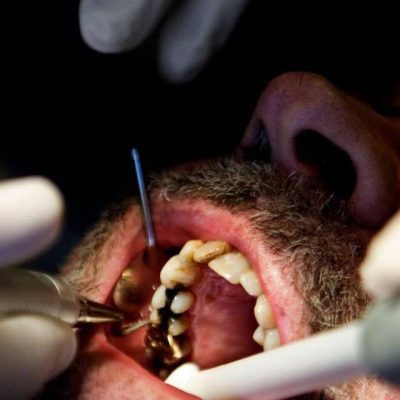 Tandlægebehandlinger til kriminelle koster skatteyderne 4,2 millioner kroner om året