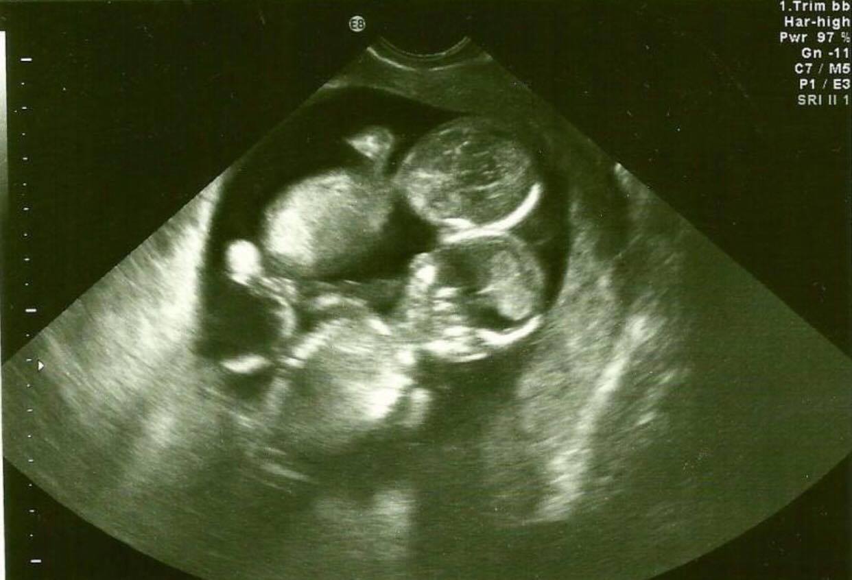 беременность 21 неделя ком в груди фото 96