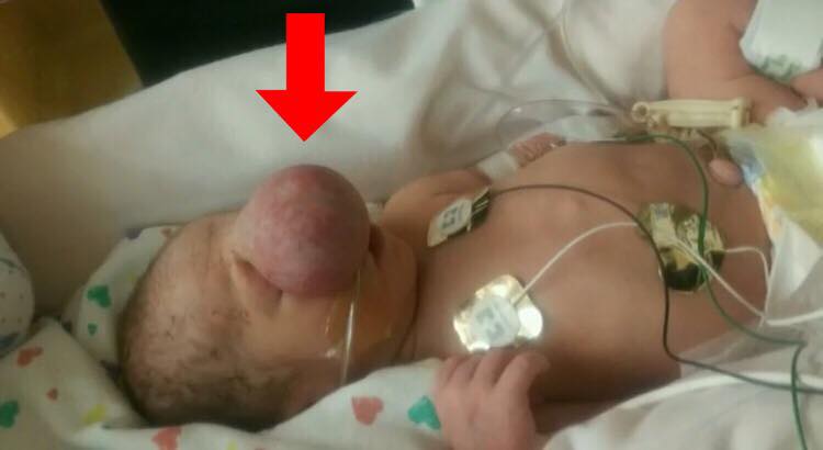 Baby fødes med defekt ansigt - morens reaktion efter operationen er hjertevarmende