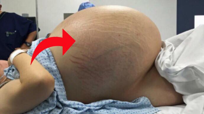 24-åriget kvinde ligner hun er gravid - men så opdager lægerne gigantisk cyste