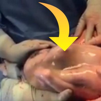 Kvinden skal være mor til trillinger - lægerne fryser til is da de ser den tredje baby stadig ligger i sin Fostersæk efter fødslen