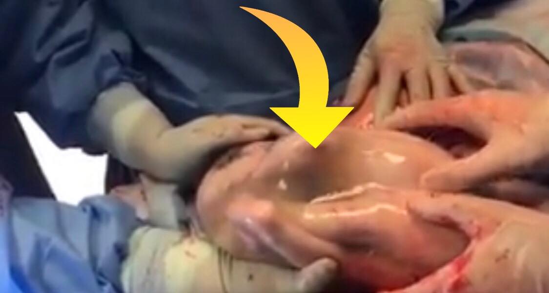 Kvinden skal være mor til trillinger - lægerne fryser til is da de ser den tredje baby stadig ligger i sin Fostersæk efter fødslen